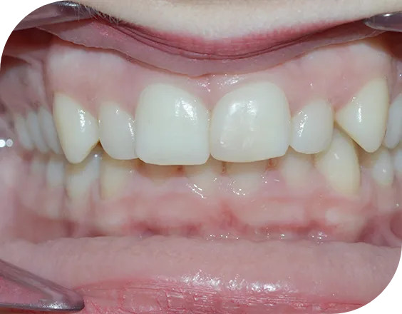 Dentadura antes de un tratamiento de ortodoncia en Clínicas Sanium