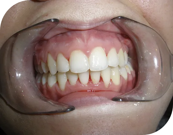 Dentadura después de un tratamiento de ortodoncia en Clínicas Sanium