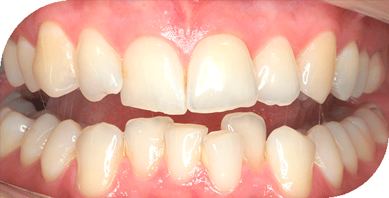 Dentadura antes de un tratamiento de ortodoncia estética en Clínicas Sanium