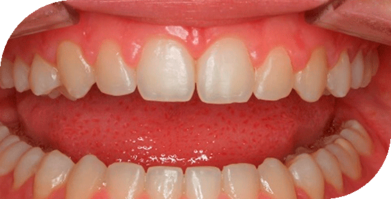 Dentadura después de un tratamiento de ortodoncia estética en Clínicas Sanium
