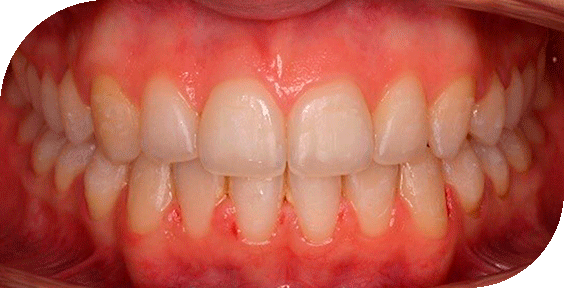 Dentadura después de un tratamiento de ortodoncia estética en Clínicas Sanium