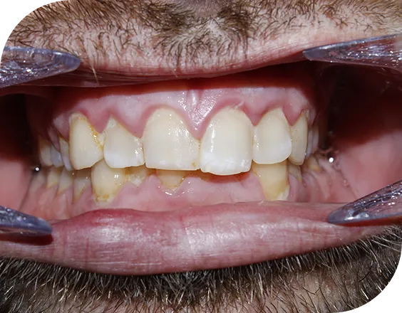 Dentadura antes de un tratamiento dental en Clínicas Sanium