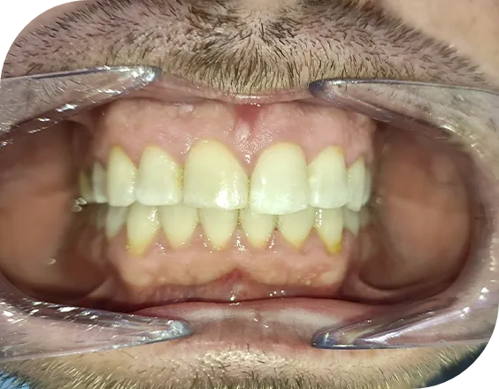 Dentadura después de un tratamiento dental en Clínicas Sanium