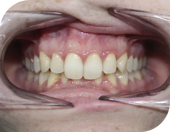 Dentadura antes de un tratamiento de blanqueamiento dental en Clínicas Sanium