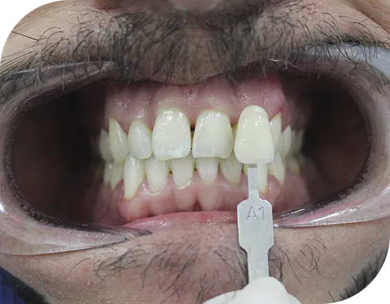 Dentadura después de un tratamiento de blanqueamiento dental en Clínicas Sanium