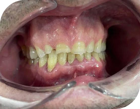 Dentadura antes de un tratamiento de Bruxismo en Clínicas Sanium