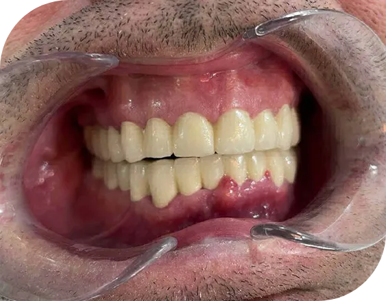 Dentadura después de un tratamiento de Bruxismo en Clínicas Sanium