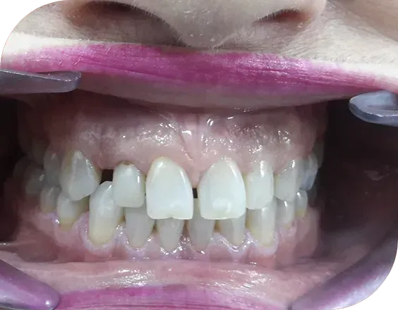 Dentadura antes de un tratamiento de carillas de composite en Clínicas Sanium
