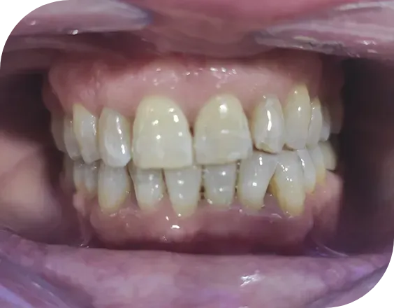Dentadura después de un tratamiento de carillas de composite en Clínicas Sanium