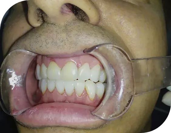 Dentadura después de un tratamiento de carillas de composite inyectado en Clínicas Sanium