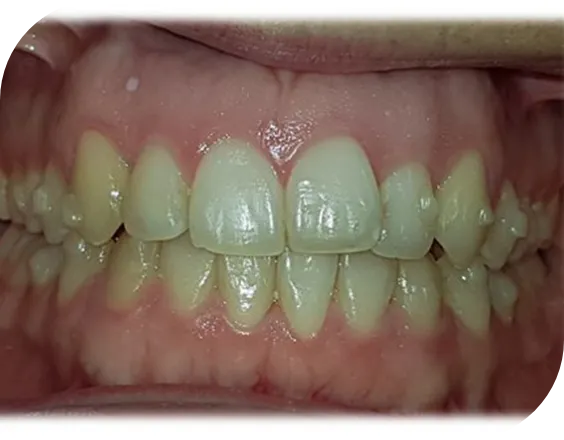 Dentadura antes de un tratamiento de ortodoncia invisible Invisaling en Clínicas Sanium