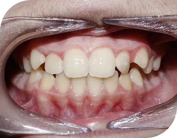 Dentadura antes de un tratamiento de ortodoncia convencional autoligada en Clínicas Sanium