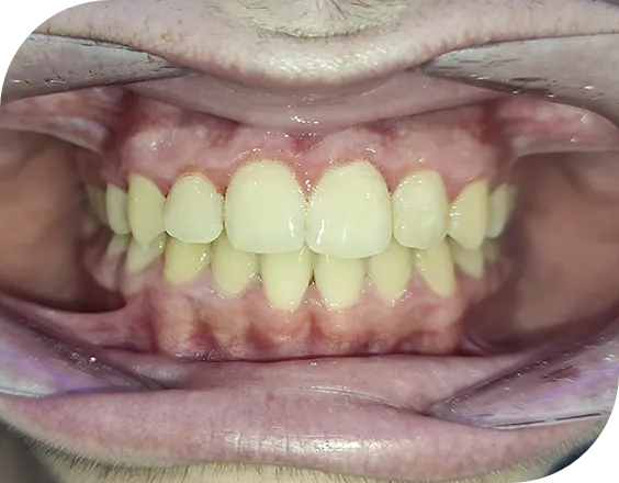 Dentadura después de un tratamiento de ortodoncia convencional autoligada en Clínicas Sanium