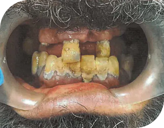 Dentadura antes de un tratamiento All on Four en Clínicas Sanium