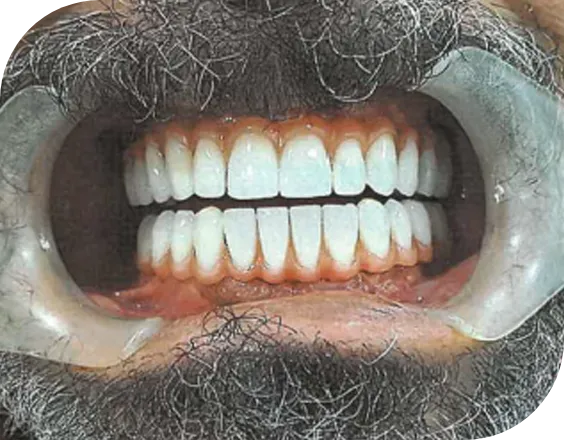Dentadura después de un tratamiento All on Four en Clínicas Sanium