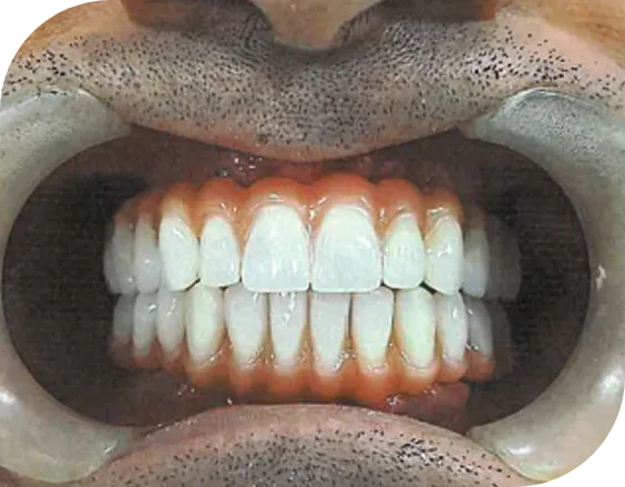 Dentadura después de un tratamiento All on Four en Clínicas Sanium