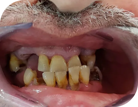 Dentadura antes de un tratamiento Locator en Clínicas Sanium