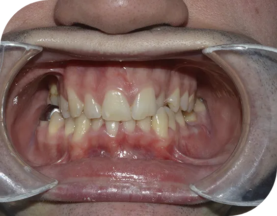 Dentadura antes de una ortodoncia convencional autoligada en Clínicas Sanium