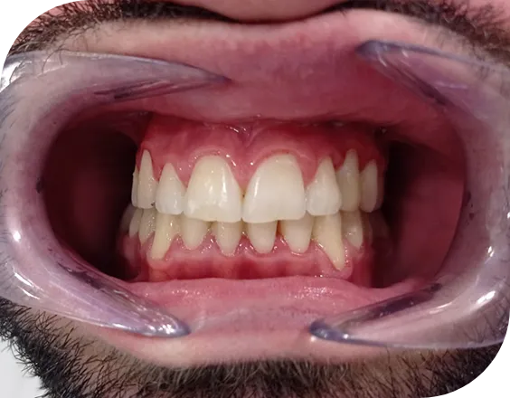 Dentadura después de una ortodoncia convencional autoligada en Clínicas Sanium