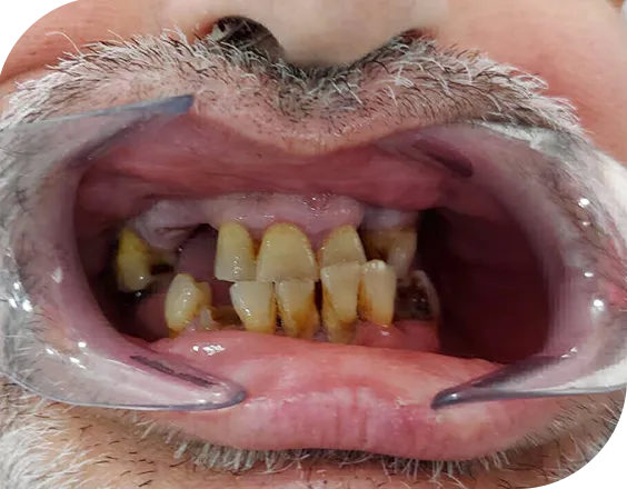 Paciente antes de un implante dental removibles en Sanium