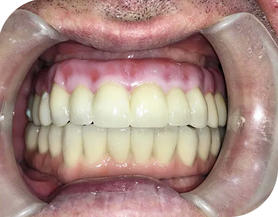 Paciente que hubo que quitarle todas las piezas dentales y colocarle 6 implantes superiores y 6 inferiores , con colocación final de prótesis fija atornillada en Sanium
