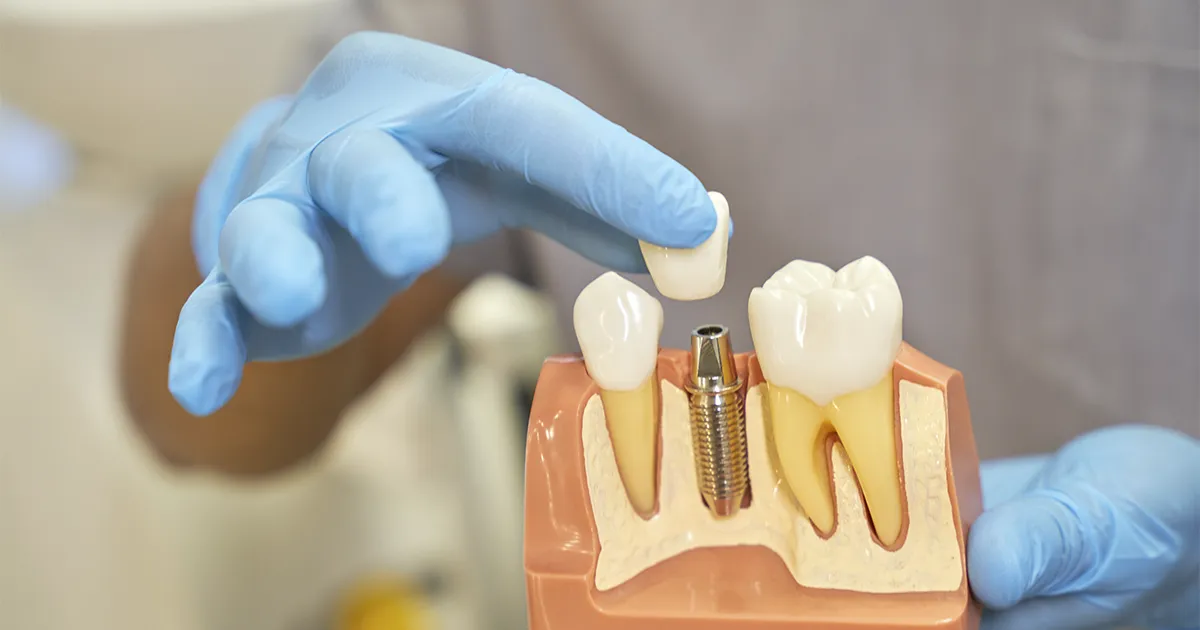 Corona dental muestra odontologo sanium clinica albacete