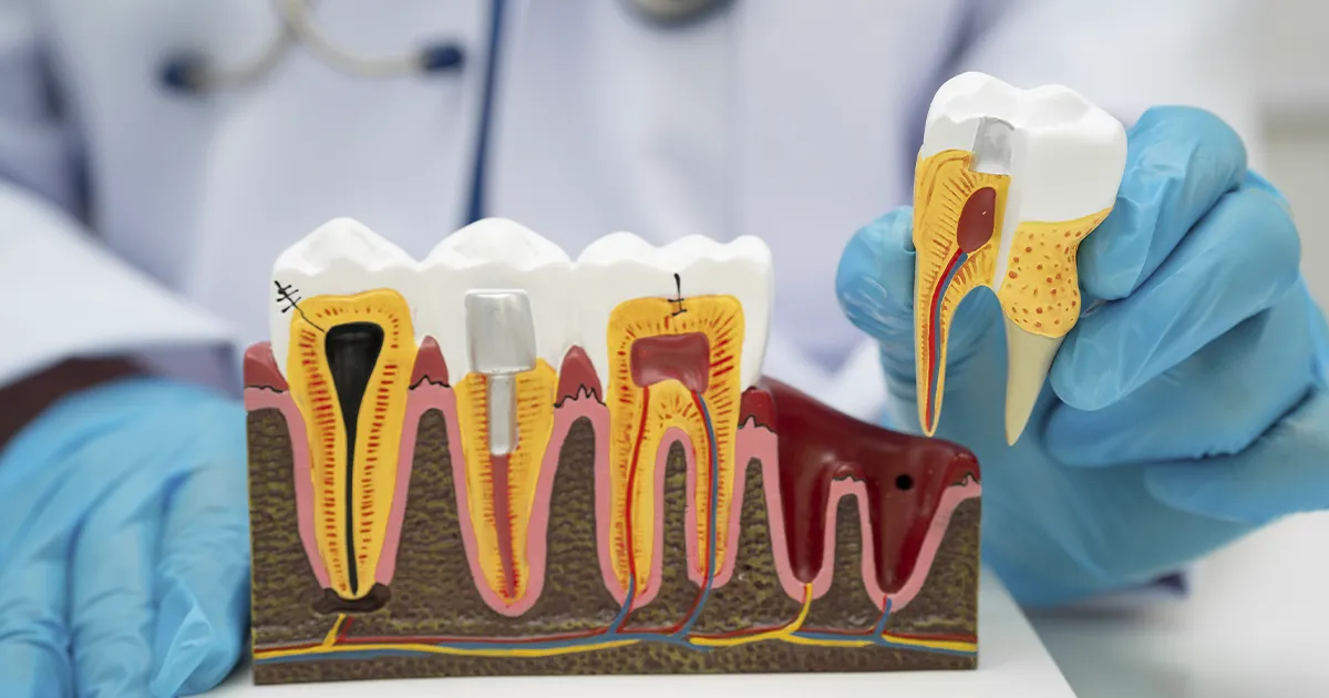 periodontitis dentista explicacion tratamiento clinica sanium albacete