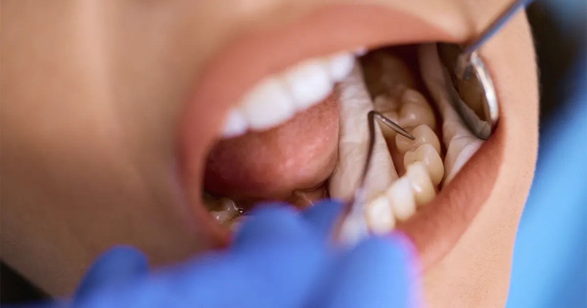 primer plano paciente empaste clinica sanium albacete